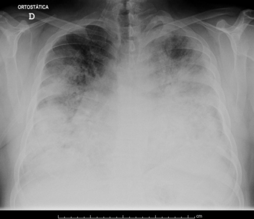 Chest radiography on admission to the Emergency Department.Extensive bilateral infiltrates involving the lower two-thirds of both lung fields can be observed.Â 