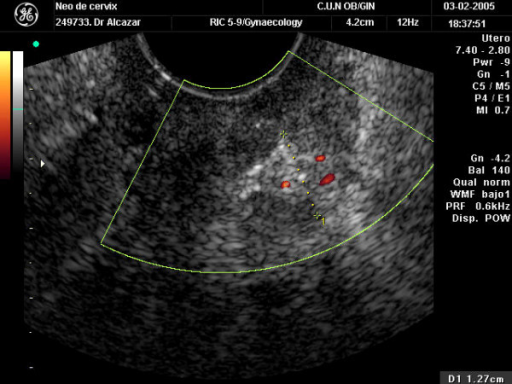 Transvaginal Color Doppler Ultrasound Showing A Cervica Open I