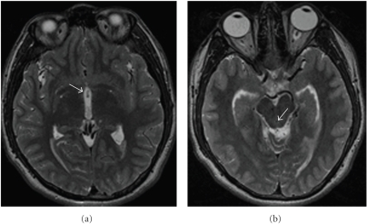 (a) MRI T2 showing migration of the cyst to the anterio | Open-i