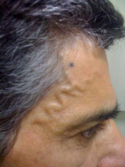 Visible, Palpable And Pulsatile Right Frontal Branch Of The Superficial ...