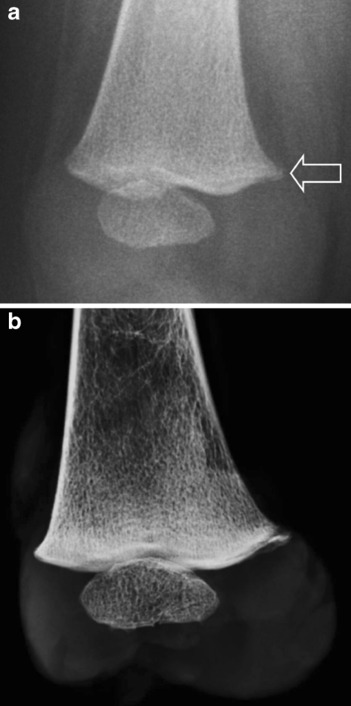 Femoral Metaphyseal Fracture