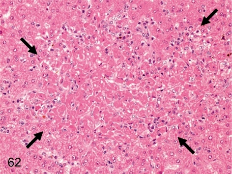 Liver: Focal necrosis of hepatocytes. A necrotic focus | Open-i