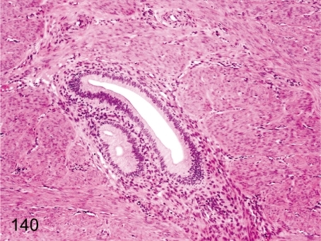 Uterus: Adenomyosis (endometriosis interna). Endometria | Open-i