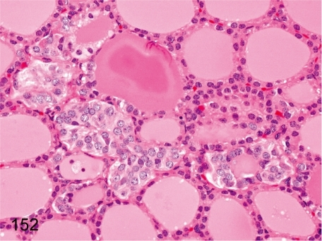 Thyroid: Focal C-cell hyperplasia. Generally, C-cells a | Open-i