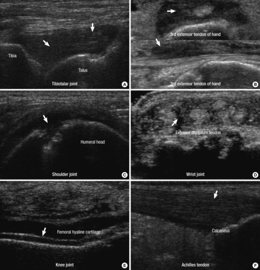 Tenosynovitis Ankle Ultrasound