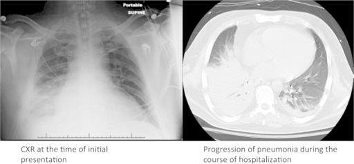 ICU admission chest X-ray: consolidation at right base; | Open-i