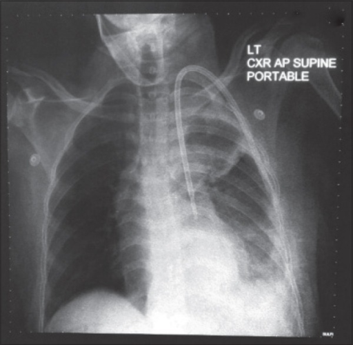 Permacath seen in the left side of the heart