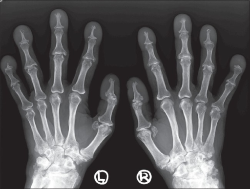 Anteroposterior radiograph of both hands shows enlargem | Open-i