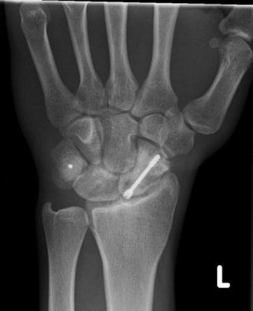 Wrist PA X-ray at 20 months suggesting scaphoid fractu | Open-i