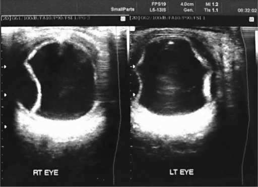 B Scan Ultrasonography Confirming Massive Choroidal Detachment In Both Eyes B Scan Ultrasonography Confirming Massive Choroidal Detachment In Both Eyes