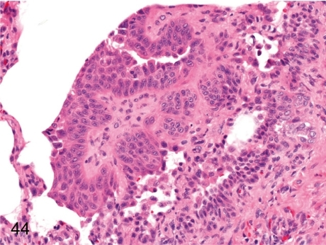 Lung: Squamous metaplasia of the bronchial epithelium. | Open-i