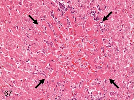 Liver: Focal necrosis of hepatocytes. A necrotic focus | Open-i