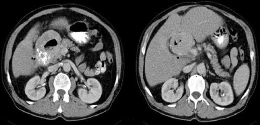 Axial CT scans of the abdomen. Duodenal GIST described | Open-i