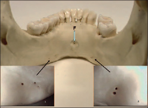 In A Dry Mandibular Specimen There Is A Superior Genia Open I 8094