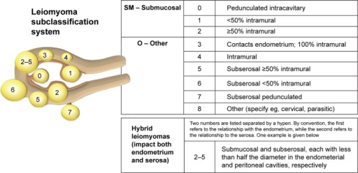 Figo Leiomyoma Subclassification System Note Reprinted From Int J