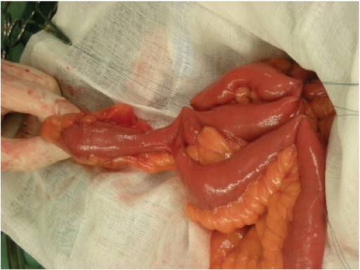 Image result for meckel's diverticulum