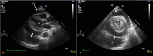 A transthoracic 2-dimensional echocardiogram. Note the | Open-i