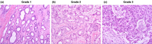 histological-grade-of-breast-cancer-as-assessed-by-the-open-i