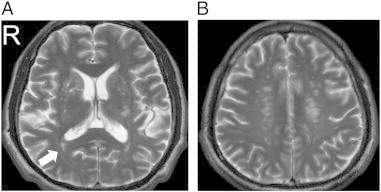 Patient 2 (49/M). (A) An old lacunar infarct in right t | Open-i