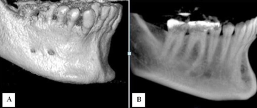 Cbct Images Show The Mental Foramen And Accessory Menta Open I 6338