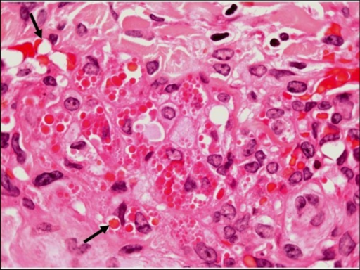 Plaque stage Kaposi sarcoma. Large numbers of intracell | Open-i