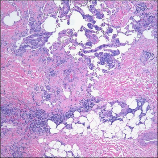 Lymphangioma-like Kaposi sarcoma seen at higher magnifi | Open-i