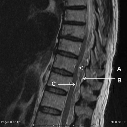 T2-weighted Mri In The Sagittal View. Abnormal Signal P 