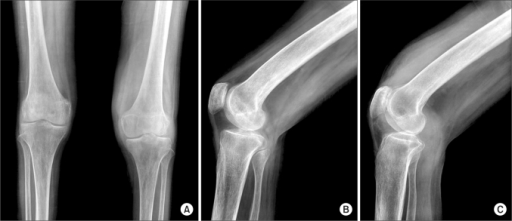 Simple radiograph of left knee shows narrowing of the p | Open-i