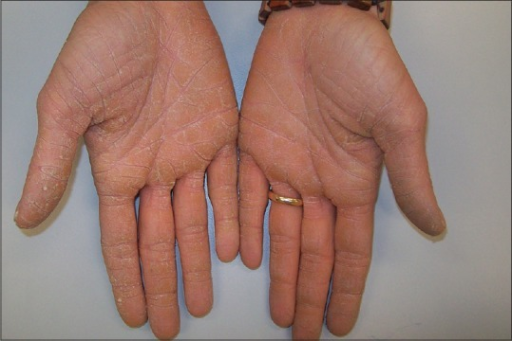 Keratoderma of the hands with a sharp demarcation of th | Open-i