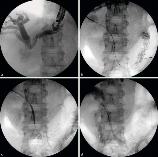 Endoscopic Ultrasound-guided Biliary Drainage (EUS-B | Open-i