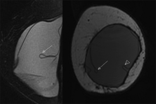 Mri Of A Woman With Intracapsular Rupture Sagittal T2 Open I