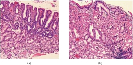 Microscopic images of endoscopic biopsy of the duodenum | Open-i