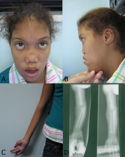 Frontal A And Side B View Of Patient S Face Note F Open I