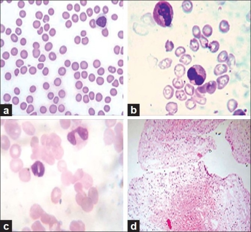 (a) Pancytopenia peripheral smear. (b, c) Pelger-Heut a | Open-i