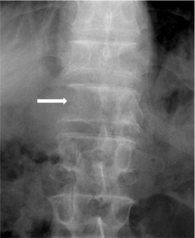 'Winking owl sign' due to osteolysis of right pedicle b | Open-i