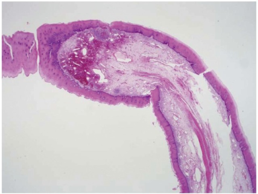 histopathological features of the fibrovascular polyp open i