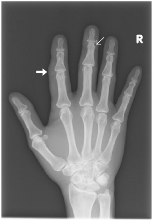 Frontal radiograph of the right hand shows focal periar | Open-i