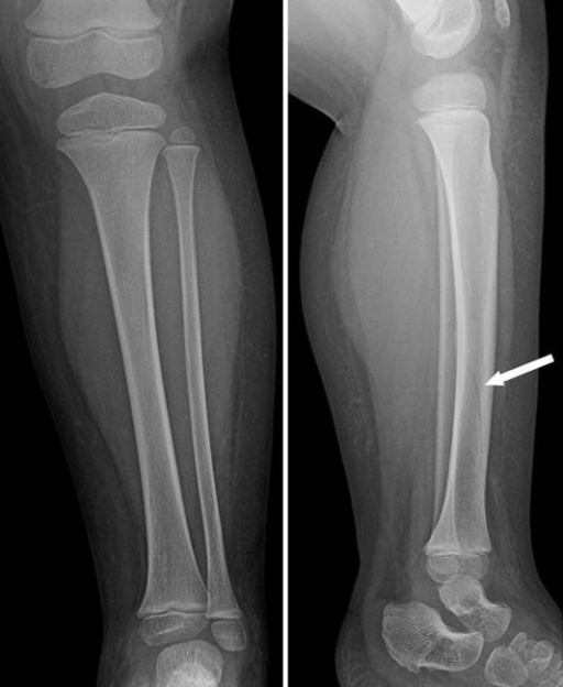 nondisplaced fracture