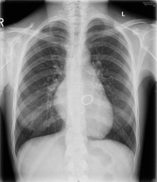 Mitral valve replacement in early childhood. Anteropost | Open-i