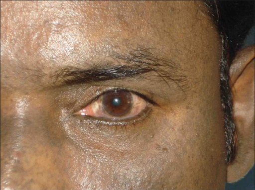Blue Brown Discoloration Of Right Sclera 