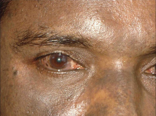 Blue Brown Discoloration Of Left Sclera 