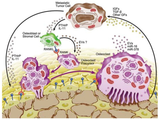 Schematic View Of Tumor-induced Osteoclast Formation. B | Open-i