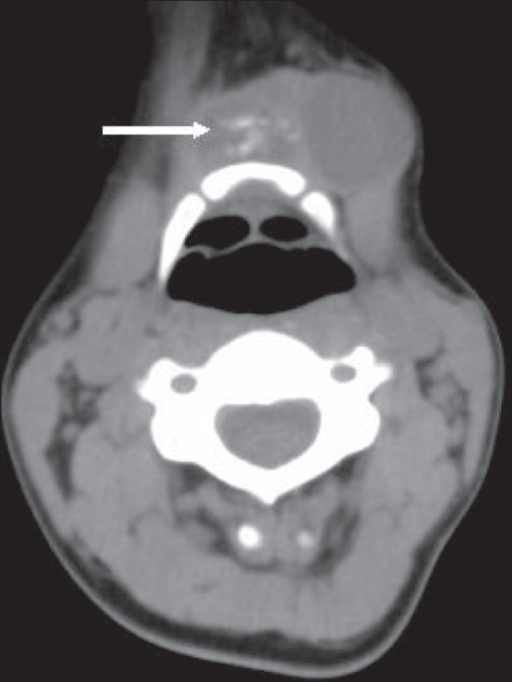 CT Neck Anatomy Hyoid Bone