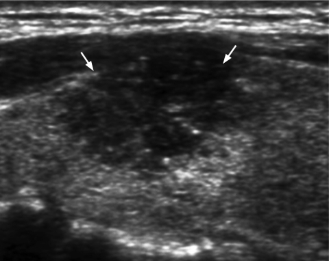 Longitudinal grey scale sonogram shows a solid, hypoech | Open-i