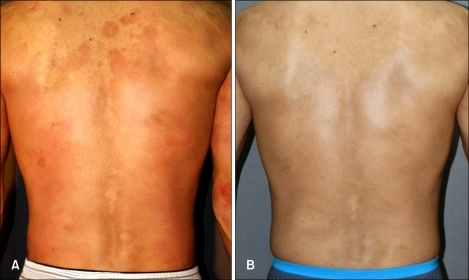 Mycosis Fungoides Stage 1