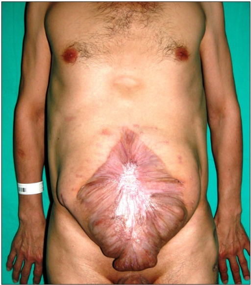 Preoperative photograph of the patient presenting a massive abdominal