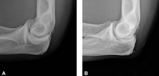 Lateral radiographic images of the same elbow in Figure | Open-i