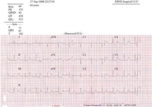 12-lead ECG displaying the patient's prolonged QT inter | Open-i