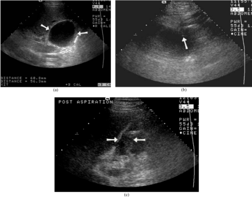 Biloma after LDLT diagnosed by US guided aspiration. (a | Open-i