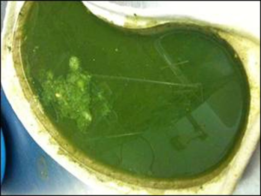 Figure 1: Typical dark green vomit often referred to as | Open-i